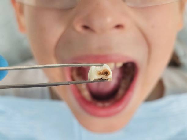Best Emergency Broken Tooth Repair in Williamsburg, FL